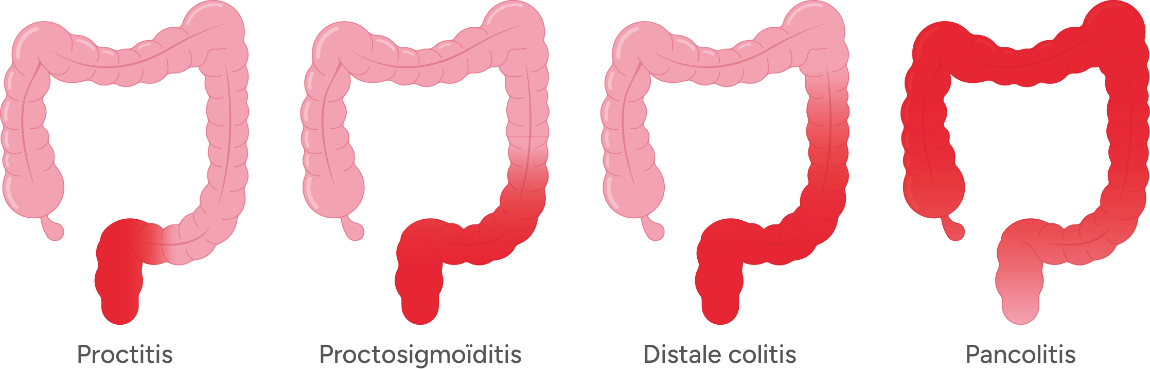 colitis ulcerosa types
